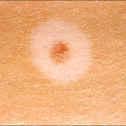 Example of moleRemoval